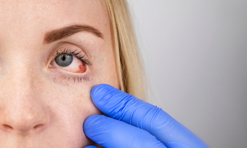 Woman having red eye checked by eye doctor