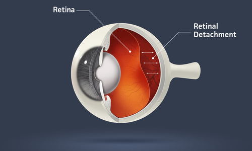 Retinal detachment 