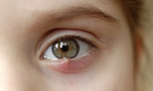 A child with a stye on the lower eyelid