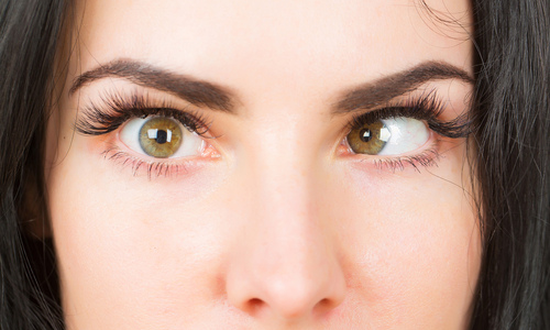 Woman with strabismus