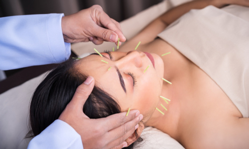 Woman getting acupuncture in her forehead