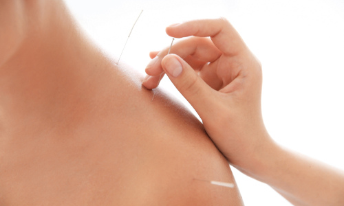 Acupuncture treatment in the shoulder