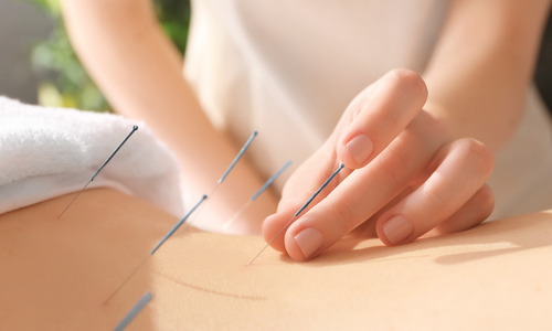 Woman getting acupuncture treatment