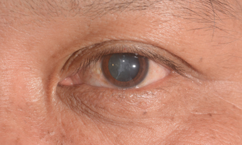 An older man with cataracts