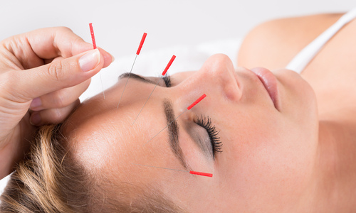 Woman getting acupuncture facial treatment