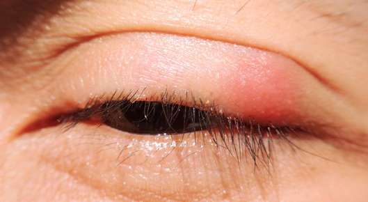 Close up image of an irritation on the eyelid.