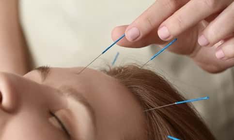 Acupuncture for headaches