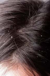 Close up image of a dry scalp.
