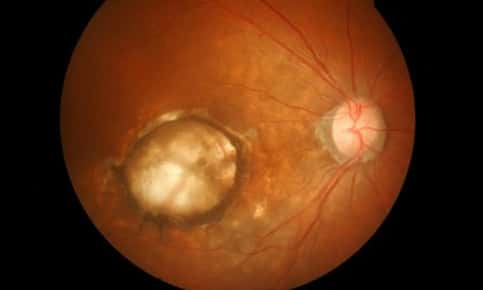 Image of an eye with age-related macular degeneration