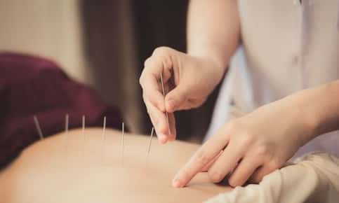 Man receiving acupuncture treatment