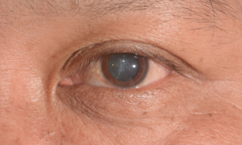 An older man with cataracts