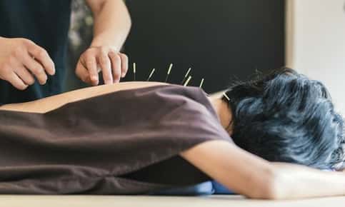 Woman receiving acupuncture treatment.