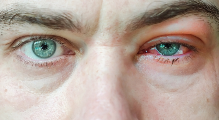 Man with blepharitis