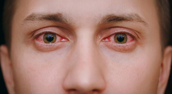 conjunctivitis