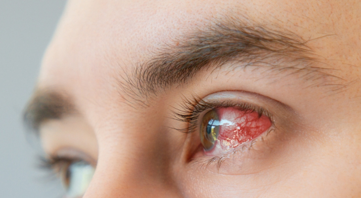 Eye infection caused by corneal abrasion