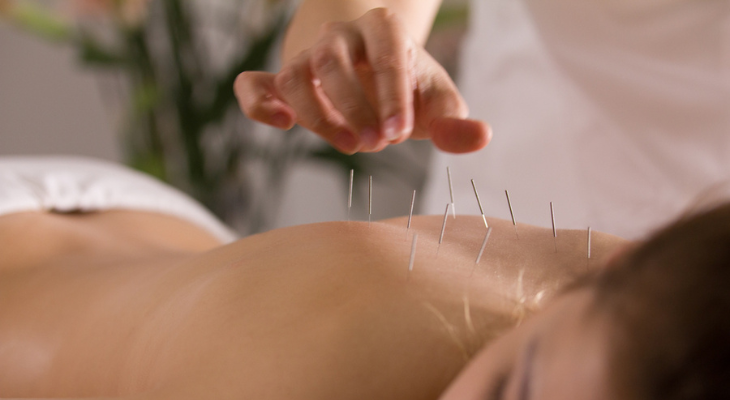 Woman of indeterminate age getting acupuncture