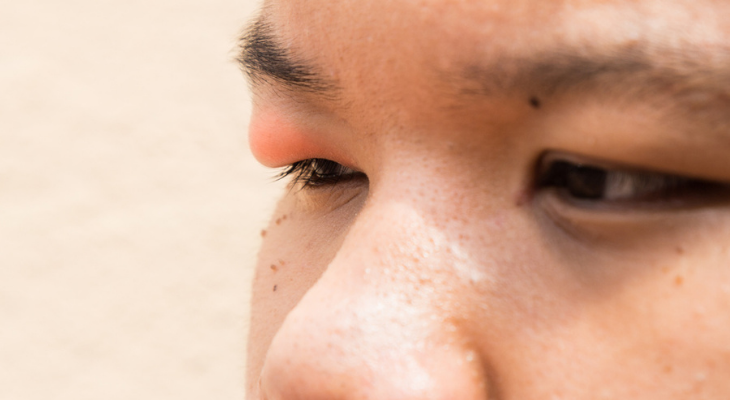 Man with swollen eyelid