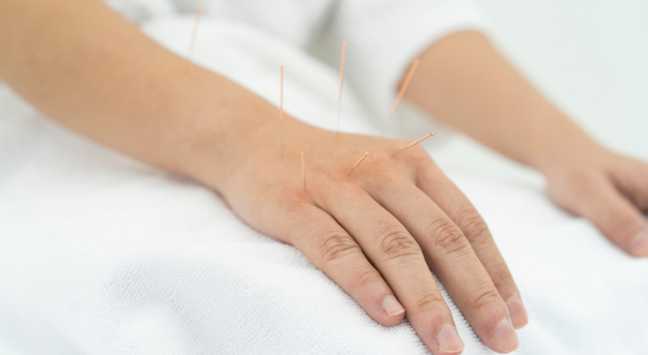 Acupuncture in hand