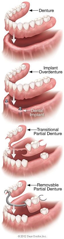 Removable denture types.