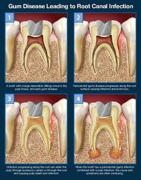 Gum disease leading to root canal infection.