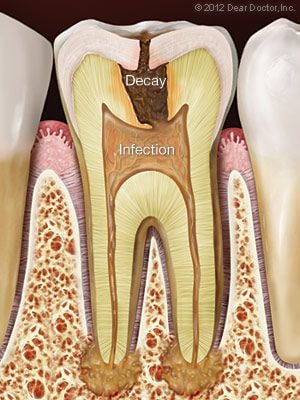 Decayed tooth with infection needing root canal treatment.