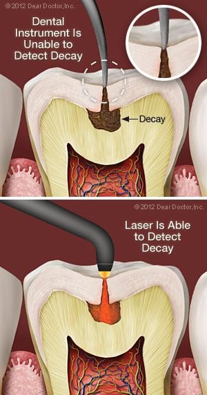 Laser decay diagnosis.