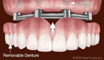 Supporting Upper Dentures with Dental Implants.