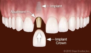 Replacing One Tooth With a Dental Implant.