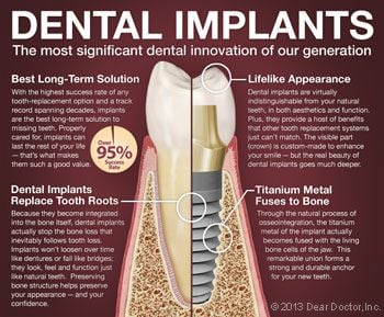 Dental Implants 101.