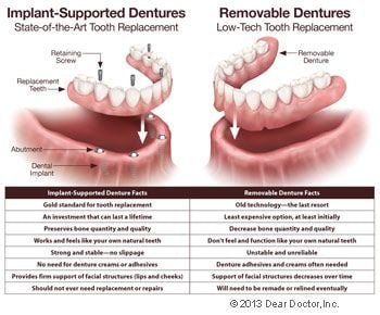 Implant supported dentures vs removable dentures.