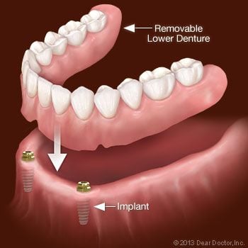 Implant-Supported Overdenture.