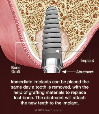 Immediate dental implant.