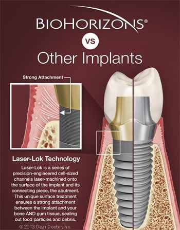 BioHorizons dental implants vs competitors.