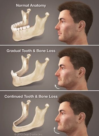 Consequences of Tooth Loss.