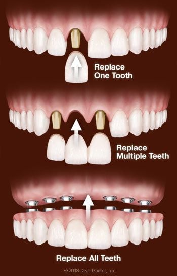 Dental Implant Treatment Options.