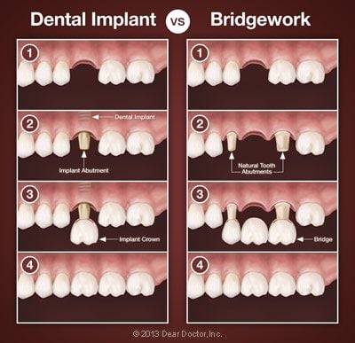 Dental implants vs bridgework.