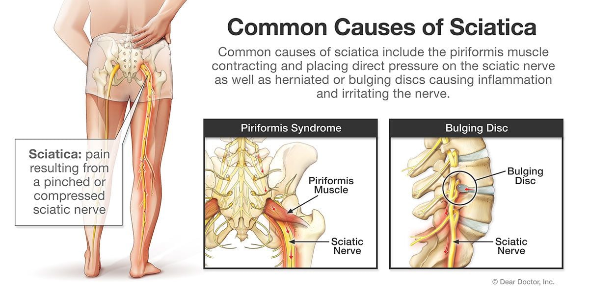 Common causes of sciatica.