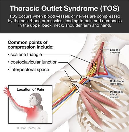 Thoracic outlet syndrome.