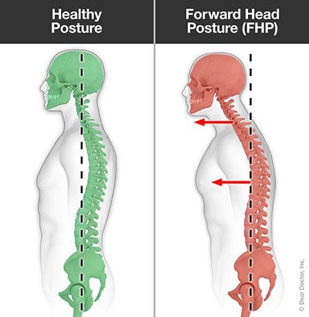 Forward head posture.