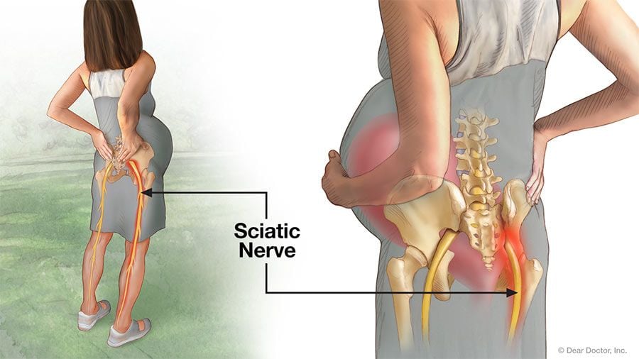 Pregnancy Pain - Sciatic Nerve.