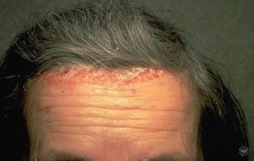 White scalp patches - Psoriasis krém