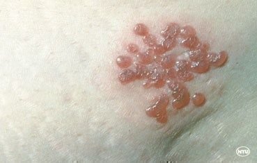 shingles-symptoms_patch.jpg