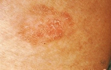 bowens-disease-slide1.jpg