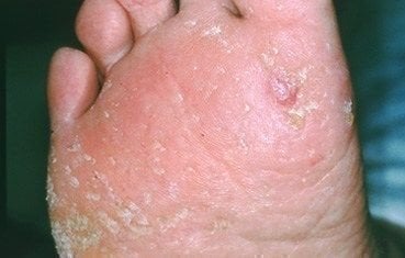 squamous-cell-carcinoma-slide4.jpg