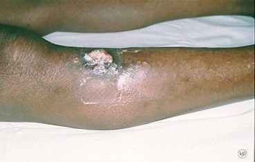 squamous-cell-carcinoma-slide5.jpg