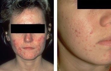 diseases-adult-acne.jpg