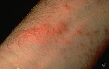 poison-ivy-symptoms-rash.jpg