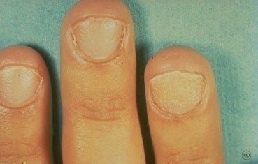Alopecia-areata_symptoms-fingernails.jpg