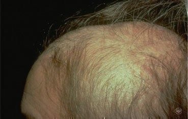 Alopecia-areata_symptoms_hair-loss.jpg