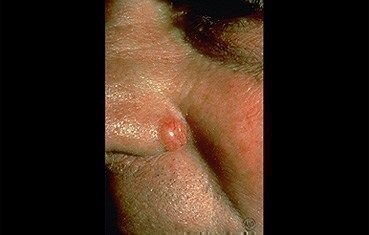 nodular-basal-cell-carcinoma-slide1.jpg